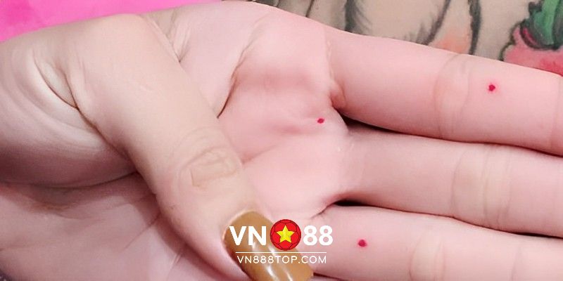 Nốt ruồi này còn được gọi với cái tên khác là nốt ruồi đỏ hay mụn ruồi son
